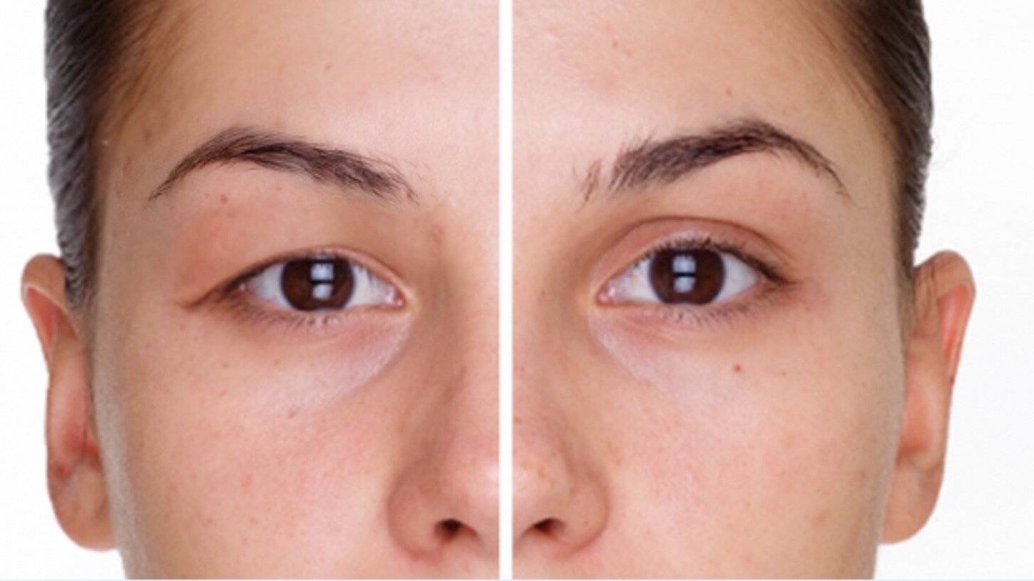 dr akyol goz kapaklarindaki sarkmalar gorme guclugune yol acabiliyor PQDzzA17